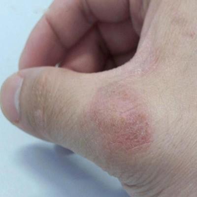 皲裂性湿疹怎么治疗 手足皲裂性湿疹怎么治疗