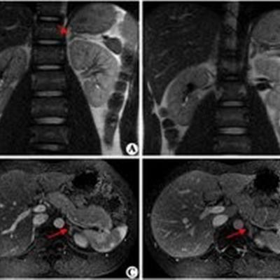 肾上腺增生的症状（肾上腺增生的症状吃什么药能缓解心悸手麻等症状）