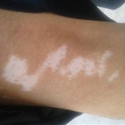 白殿疯病能治好吗 白殿疯病可以治愈吗