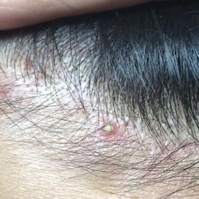 头皮毛囊炎怎么根治（头皮毛囊炎怎么办）