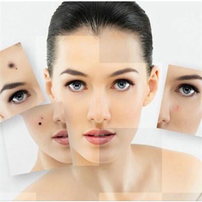 激光点痣多少钱一颗（美容院激光点痣多少钱一颗）