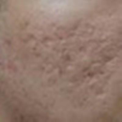 白醋祛痘印效果好吗 白醋对痘印有效果吗