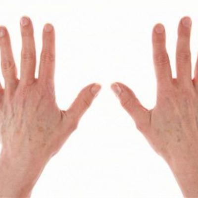 湿疹症状有哪些（湿疹有什么特征）