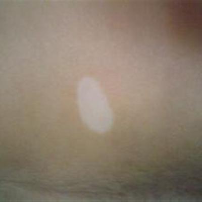 治疗白癫疯偏方有哪些（什么药治白疯癫有效果）