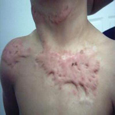 烫伤疤痕怎么去除（脸上有烫伤疤痕怎么去除）