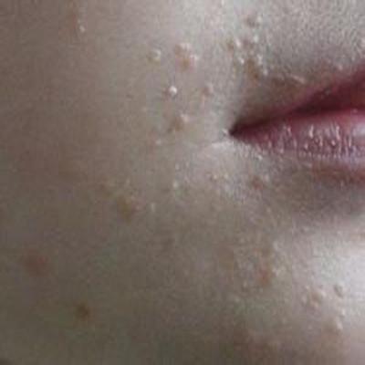 脸上扁平疣治疗方法有哪些 脸上扁平疣的最佳治疗方法