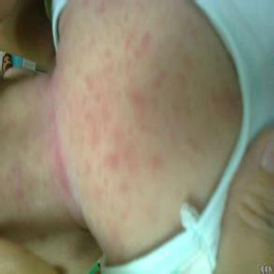 小儿湿疹症状图片有哪些（小儿湿疹的种类和症状图片）