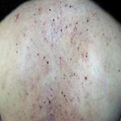 酒糟性皮炎怎么造成的（酒糟型皮炎）