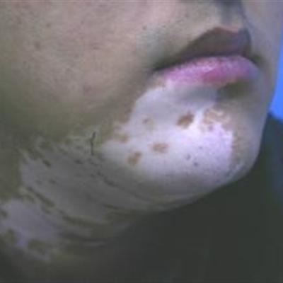 白癜风早期有什么症状