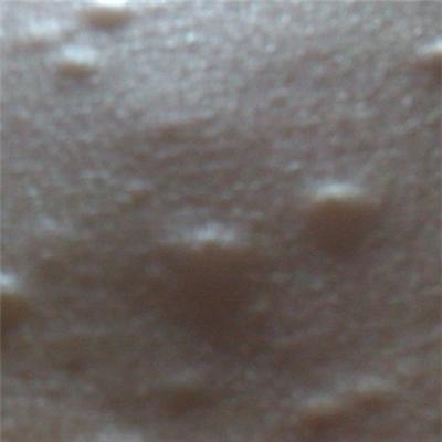 皮下脂肪瘤病因是什么（皮下脂肪瘤的形成原因）