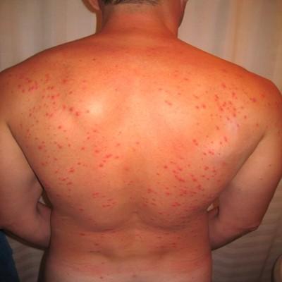 疱疹是怎么引起的（什么原因引起的疱疹）