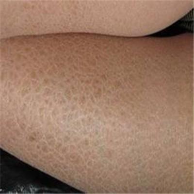 鱼鳞病怎么能治好（鱼鳞病怎么治疗?有好的办法吗?）