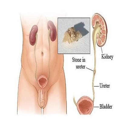 肾结石堵住输尿管怎么办（结石堵住了输尿管怎么办）