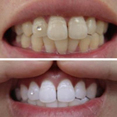 牙周炎根治怎么办（牙周炎怎么根治?）