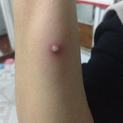 火疖子是什么（火疖子是什么原因引起的）