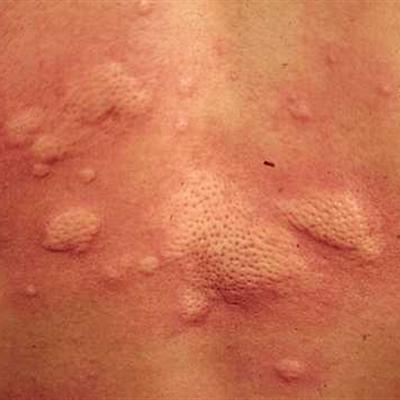 荨麻疹的治疗方法有哪些（荨麻疹的治疗方法有哪些忌口）