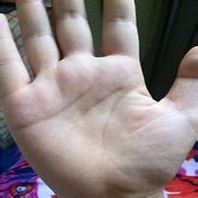 右手第五掌骨骨折怎么办（右手第五掌骨骨折怎么办啊）