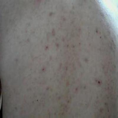 痘印留下的黑色的印怎么去掉（长痘痘留下的黑印怎么去掉）