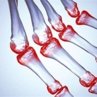 类风湿因子高达1000多怎么回事 类风湿因子高达4000多