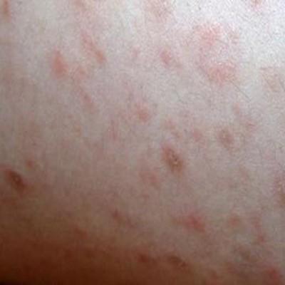 牛皮癣会传染人吗 皮癣会不会传染给别人