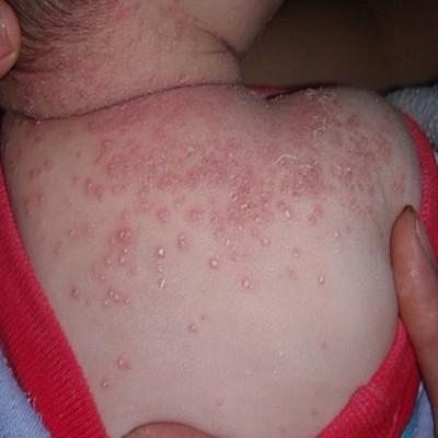 湿疹能治好吗 皮肤湿疹可以根治吗