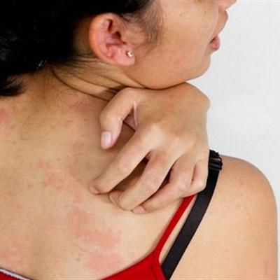 湿疹要注意什么（阴囊湿疹要注意什么）