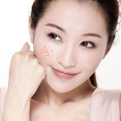 下巴长痘痘怎么办 下巴起痘痘的原因以及解决办法