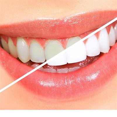 牙齿美白价格表 牙齿美白大概价格表