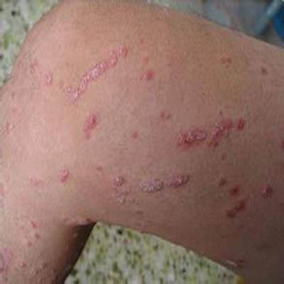 治牛皮鲜有什么药（牛皮鲜有什么特效药）