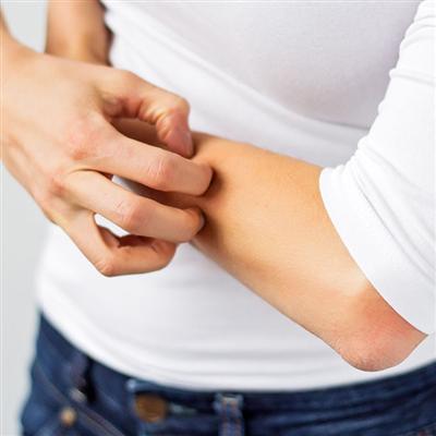 荨麻疹症状治疗方法（荨麻疹症状和治疗方法）