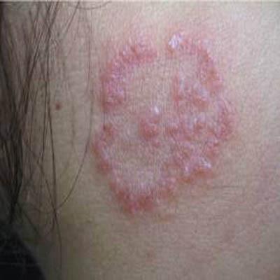 体癣怎么治好（体癣该怎么治疗）