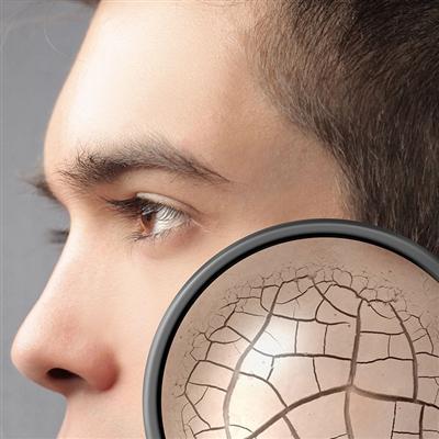 花斑癣是什么 花斑癣是什么菌引起的