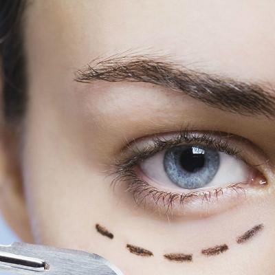 割双眼皮术的最佳时期是什么时候?（什么时候适合做双眼皮手术）