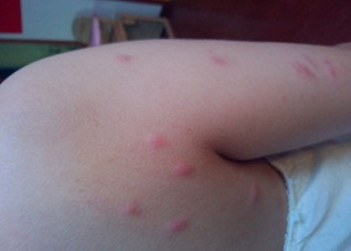 过敏起疙瘩怎么办 无缘无故过敏起疙瘩怎么办