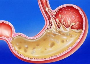 胃酸恶心怎么处理（胃酸恶心怎么回事）