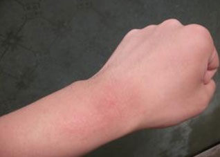 常吃四种食物预防过敏（常吃四种食物预防过敏吗）