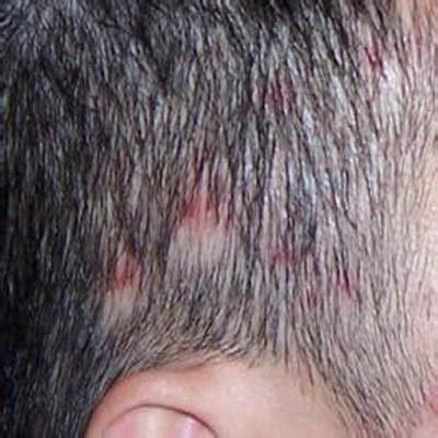 头皮毛囊炎怎么引起的（头皮毛囊炎）