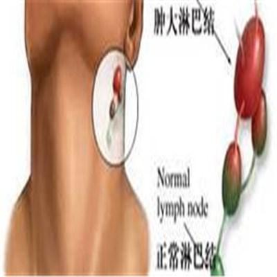 非霍奇金淋巴瘤应该做什么检查（非霍奇金淋巴瘤实验室检查）