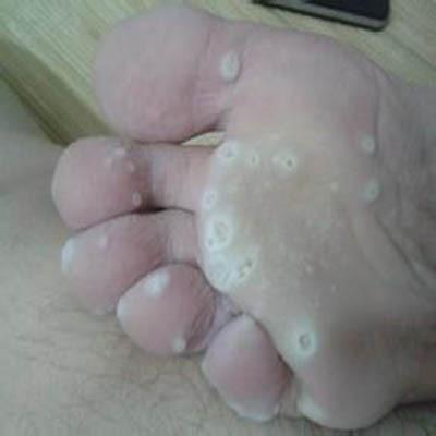 脚气怎么根治好（脚气怎么根治好的快）