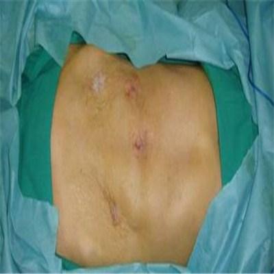 直肠癌83岁还能做手术吗（84岁直肠癌能手术吗）