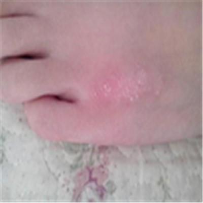 为什么得皮癣（为什么会得皮癣）