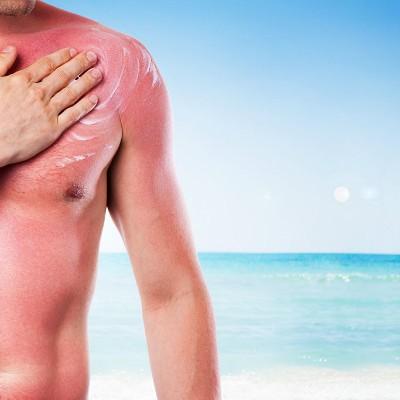 日光性皮炎用什么药（日光性皮炎用什么药最好）