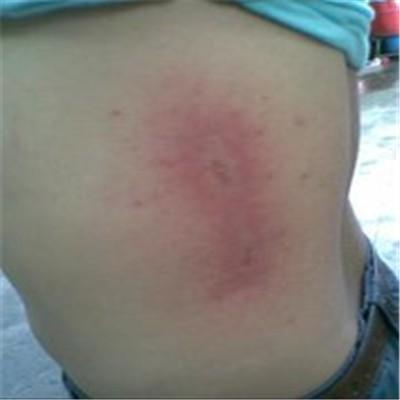 季节性皮肤过敏怎么办（小孩子季节性皮肤过敏怎么办）