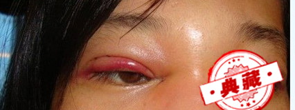 做双眼皮后注意事项（做双眼皮后注意事项有哪些呢）