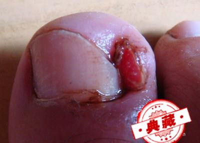 甲沟炎最佳治疗方法是什么 甲沟炎最佳治疗方法是什么图片