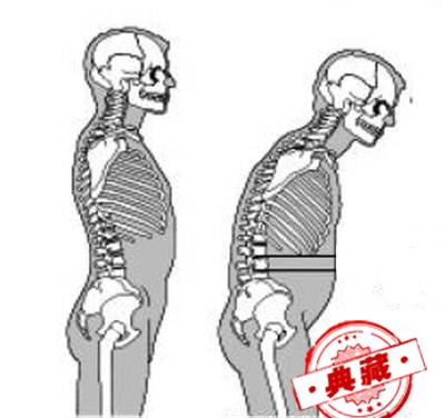 强直性脊柱炎饮食生活等应该注意哪些