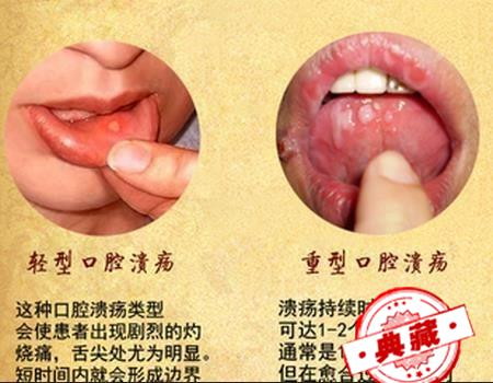 治疗口腔溃疡的超级妙方，神！（治好口腔溃疡妙方）