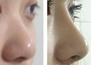 隆鼻手术的程序是什么 隆鼻术手术的手术过程
