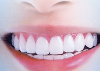 牙齿美白的5个窍门让你更自信（牙齿美白有这几种方法）