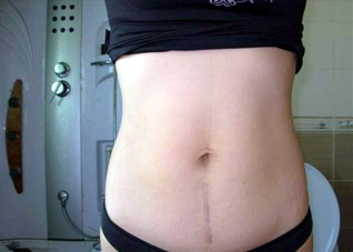 剖腹产后留下疤痕怎么办（剖腹产有疤痕怎么办）